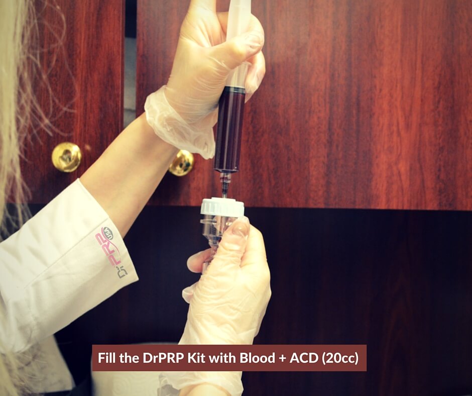 PRP Specialist Filling the PRP Kit with Blood + 20cc of ACD